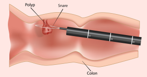 Image of colonoscopy with polyp removal.