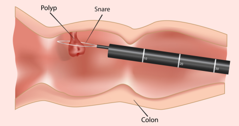 Image of colonoscopy with polyp removal.